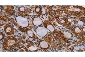 Immunohistochemistry of paraffin-embedded Human thyroid cancer tissue using FABP3 Polyclonal Antibody at dilution 1:40 (FABP3 antibody)