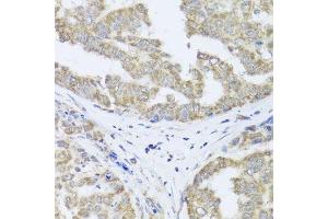 Immunohistochemistry of paraffin-embedded human liver cancer using TIMM10B antibody. (TIMM10B antibody  (AA 1-103))