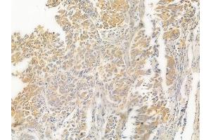 ABIN6263107 and ABIN6267016 at 1/100 staining human lung squamous cell carcinoma by IHC-P. (MAP3K4 antibody  (N-Term))