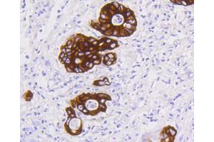 Paraformaldehyde-fixed, paraffin embedded Human stomach carcinoma tissue, Antigen retrieval by boiling in sodium citrate buffer (pH6) for 15min, Block endogenous peroxidase by 3% hydrogen peroxide for 30 minutes, Blocking buffer at 37°C for 20min, Antibody incubation with Cytokeratin 19 (2F3) Monoclonal Antibody  at 1:50 overnight at 4°C, followed by a conjugated secondary and DAB staining. (Cytokeratin 19 antibody)