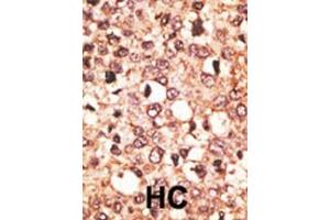 Formalin-fixed and paraffin-embedded human cancer tissue reacted with the primary antibody, which was peroxidase-conjugated to the secondary antibody, followed by AEC staining. (CRY1 antibody  (C-Term))