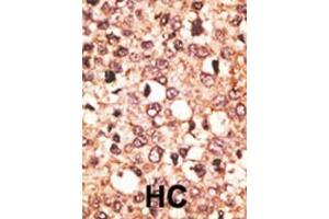 Formalin-fixed and paraffin-embedded human cancer tissue reacted with the primary antibody, which was peroxidase-conjugated to the secondary antibody, followed by AEC staining.