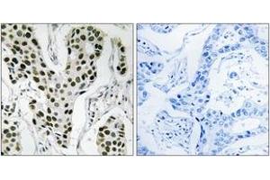 Immunohistochemistry analysis of paraffin-embedded human breast carcinoma tissue, using ZC3H4 Antibody. (ZC3H4 antibody  (AA 771-820))