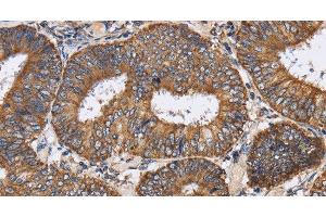 Immunohistochemistry of paraffin-embedded Human colon cancer tissue using PDGFC Polyclonal Antibody at dilution 1:40 (PDGFC antibody)