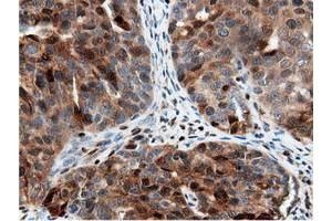 Immunohistochemical staining of paraffin-embedded Adenocarcinoma of Human colon tissue using anti-NT5DC1 mouse monoclonal antibody. (NT5DC1 antibody)