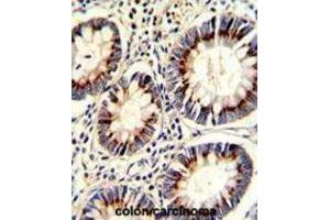 Immunohistochemistry (IHC) image for anti-Thymidylate Synthetase (TYMS) antibody (ABIN3002747) (TYMS antibody)