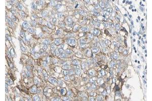 ABIN6268724 at 1/100 staining human lung carcinoma sections by IHC-P. (PAI1 antibody  (Internal Region))