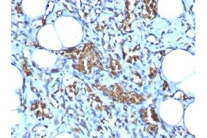 Formalin-fixed, paraffin-embedded human Angiosarcoma stained with Glycophorin A Mouse Monoclonal Antibody (GYPA/280). (CD235a/GYPA antibody)