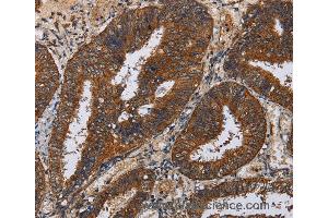 Immunohistochemistry of Human liver cancer using KLK11 Polyclonal Antibody at dilution of 1:50