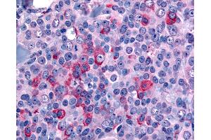 Anti-NANP antibody IHC of human Breast, Carcinoma.