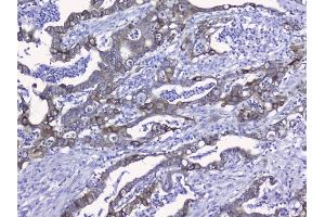 IHC analysis of Cytokeratin 19 using anti-Cytokeratin 19 antibody (ABIN3043288). (Cytokeratin 19 antibody  (C-Term))