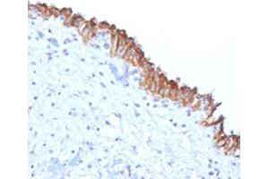 IHC testing of FFPE human bladder carcinoma with MAML2 antibody (clone MMLP2-1). (MAML2 antibody)