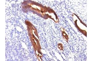 Formalin-fixed, paraffin-embedded human endometrial carcinoma stained with EMA antibody (MUC1/845). (MUC1 antibody)
