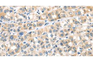 Immunohistochemistry of paraffin-embedded Human esophagus cancer tissue using RIPK4 Polyclonal Antibody at dilution 1:40 (RIPK4 antibody)