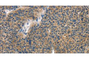 Immunohistochemistry of paraffin-embedded Human liver cancer tissue using COL4A2 Polyclonal Antibody at dilution 1:70 (COL4a2 antibody)