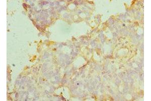 Immunohistochemistry of paraffin-embedded human endometrial cancer using ABIN7159417 at dilution of 1:100
