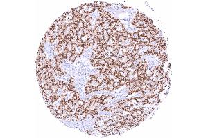 Pancreatic neuroendocrine tumor with strong predominantly nuclear Pax6 positivity of all tumor cells (PAX6 antibody)