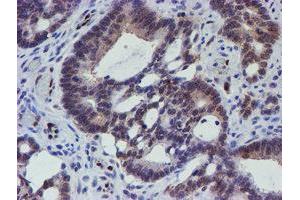 Immunohistochemical staining of paraffin-embedded Adenocarcinoma of Human colon tissue using anti-ELK3 mouse monoclonal antibody. (ELK3 antibody)