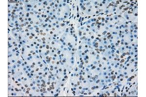 Immunohistochemical staining of paraffin-embedded Adenocarcinoma of colon tissue using anti-PRKYmouse monoclonal antibody. (PRKY antibody)
