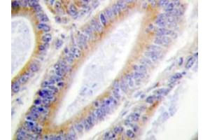 Immunohistochemistry analyzes of Casein Kinase I α antibody in paraffin-embedded human colon carcinoma tissue. (CSNK1A1 antibody)