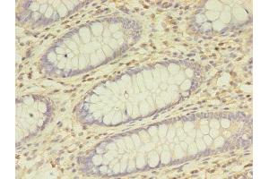 Immunohistochemistry of paraffin-embedded human colon cancer using ABIN7145885 at dilution of 1:100 (BTN3A1 antibody  (AA 30-254))