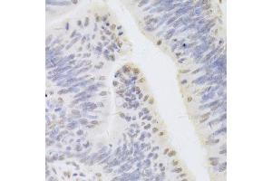 Immunohistochemistry of paraffin-embedded human rectal cancer using HDGF Antibody.