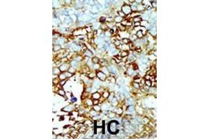 Formalin-fixed and paraffin-embedded human cancer tissue reacted with the primary antibody, which was peroxidase-conjugated to the secondary antibody, followed by AEC staining. (MAP4K2 antibody  (AA 288-319))