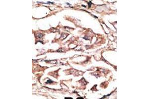 Formalin-fixed and paraffin-embedded human cancer tissue reacted with the primary antibody, which was peroxidase-conjugated to the secondary antibody, followed by AEC staining. (DKK2 antibody  (C-Term))