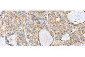 Immunohistochemistry of paraffin-embedded Human thyroid cancer tissue using CLTB Polyclonal Antibody at dilution of 1:70(x200) (CLTB antibody)