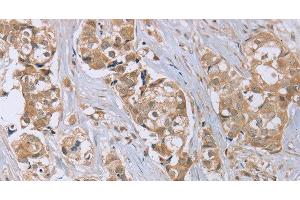Immunohistochemistry of paraffin-embedded Human breast cancer tissue using RAB6C Polyclonal Antibody at dilution 1:45 (WTH3DI antibody)