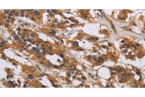 Immunohistochemistry of paraffin-embedded Human thyroid cancer using IL5RA Polyclonal Antibody at dilution of 1:40 (IL5RA antibody)
