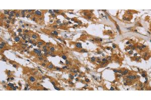 Immunohistochemistry of paraffin-embedded Human thyroid cancer using IL5RA Polyclonal Antibody at dilution of 1:40 (IL5RA antibody)