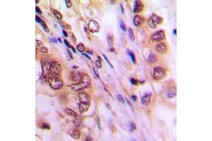 Immunohistochemical analysis of Aurora A staining in human lung cancer formalin fixed paraffin embedded tissue section. (Aurora A antibody  (C-Term))