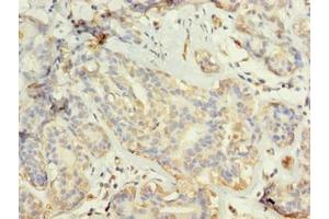Immunohistochemistry of paraffin-embedded human breast cancer using ABIN7173703 at dilution of 1:100 (TUBG2 antibody  (AA 276-451))