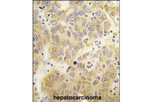Formalin-fixed and paraffin-embedded human hepatocarcinoma tissue reacted with the VARS antibody , which was peroxidase-conjugated to the secondary antibody, followed by DAB staining. (VARS antibody  (N-Term))