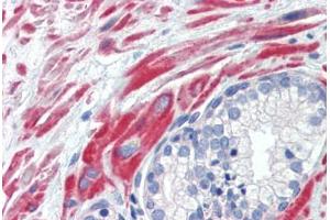 Human Prostate (formalin-fixed, paraffin-embedded) stained with SSX4 antibody ABIN462200 followed by biotinylated goat anti-rabbit IgG secondary antibody ABIN481713, alkaline phosphatase-streptavidin and chromogen. (SSX4 antibody  (AA 108-157))