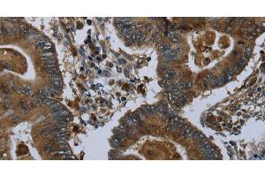Immunohistochemistry of paraffin-embedded Human colon cancer using GLUL Polyclonal Antibody at dilution of 1:60 (GLUL antibody)
