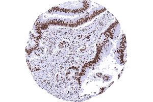 Colon Colorectal adenocarcinoma with strong MSH2 immunostaining in cancer cells and in stromal cells (Recombinant MSH2 antibody)