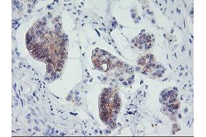 Immunohistochemical staining of paraffin-embedded Carcinoma of Human pancreas tissue using anti-MLF1 mouse monoclonal antibody.