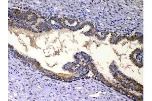 IHC analysis of IGFBP2 using anti-IGFBP2 antibody .