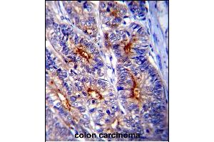 LGALS3 Antibody (C-term) (ABIN1536595 and ABIN2843799) immunohistochemistry analysis in formalin fixed and paraffin embedded human colon carcinoma followed by peroxidase conjμgation of the secondary antibody and DAB staining. (Galectin 3 antibody  (C-Term))