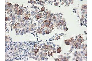Immunohistochemical staining of paraffin-embedded Carcinoma of Human lung tissue using anti-FAM119A mouse monoclonal antibody.
