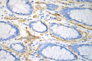 Immunohistochemistry was performed on paraffin-embedded human sigmoid colon carcinoma using caveolin 1 antibody (ABIN7797944), 1:200). (Recombinant Caveolin-1 antibody)