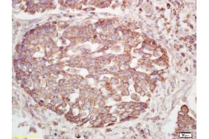 Formalin-fixed and paraffin embedded human lung carcinoma labeled with Rabbit Anti Phospho-Insulin Receptor Beta(Tyr1185) Polyclonal Antibody, Unconjugated (ABIN802293) at 1:200 followed by conjugation to the secondary antibody and DAB staining (ISR-beta antibody  (pTyr1185))