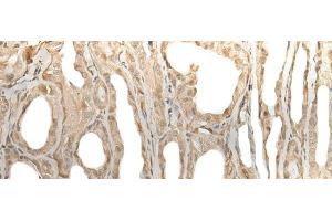 Immunohistochemistry of paraffin-embedded Human thyroid cancer tissue using ZBTB18 Polyclonal Antibody at dilution of 1:50(x200) (ZNF238 antibody)