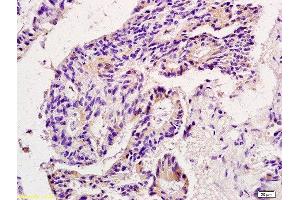 Formalin-fixed and paraffin embedded human colon carcinoma labeled with Anti-MMP9 Polyclonal Antibody, Unconjugated  at 1:200 followed by conjugation to the secondary antibody and DAB staining. (MMP 9 antibody  (AA 151-250))