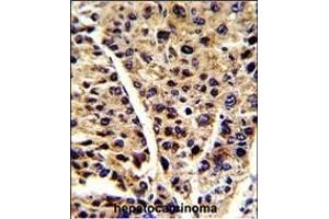 Formalin-fixed and paraffin-embedded human hepatocarcinoma reacted with ENOB Antibody (Center), which was peroxidase-conjugated to the secondary antibody, followed by DAB staining. (ENO3 antibody  (AA 237-264))