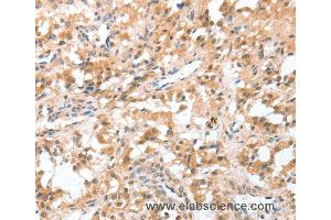 Immunohistochemistry of Human thyroid cancer using CIDEC Polyclonal Antibody at dilution of 1:50