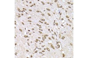 Immunohistochemistry of paraffin-embedded human colon carcinoma using LMNB2 Antibody (ABIN5973877) at dilution of 1/200 (40x lens). (Lamin B2 antibody)