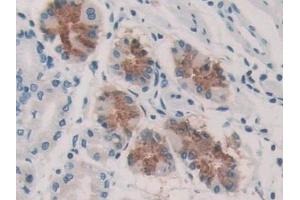Detection of KARS in Human Stomach cancer Tissue using Polyclonal Antibody to Lysyl tRNA Synthetase (KARS) (KARS antibody  (AA 323-553))